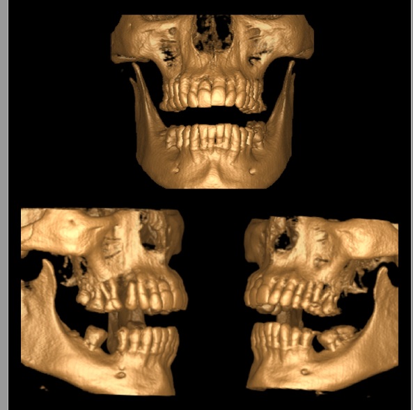 A. Maxila e mandíbula em oclusão frontal inicial, mostrando a